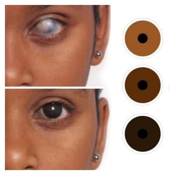 LENTES DE CONTACTO PROTÉSICOS